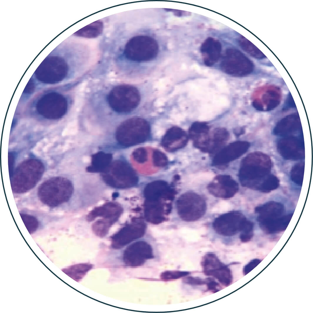 Eosinofili